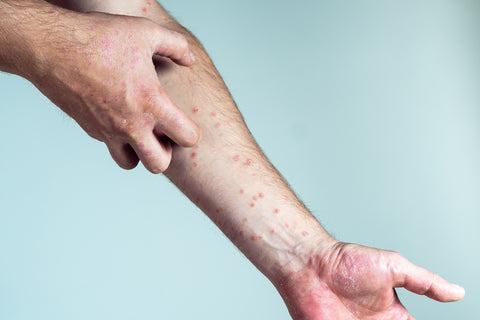 Több mint bőrbetegség – A pikkelysömör több figyelmet igényel